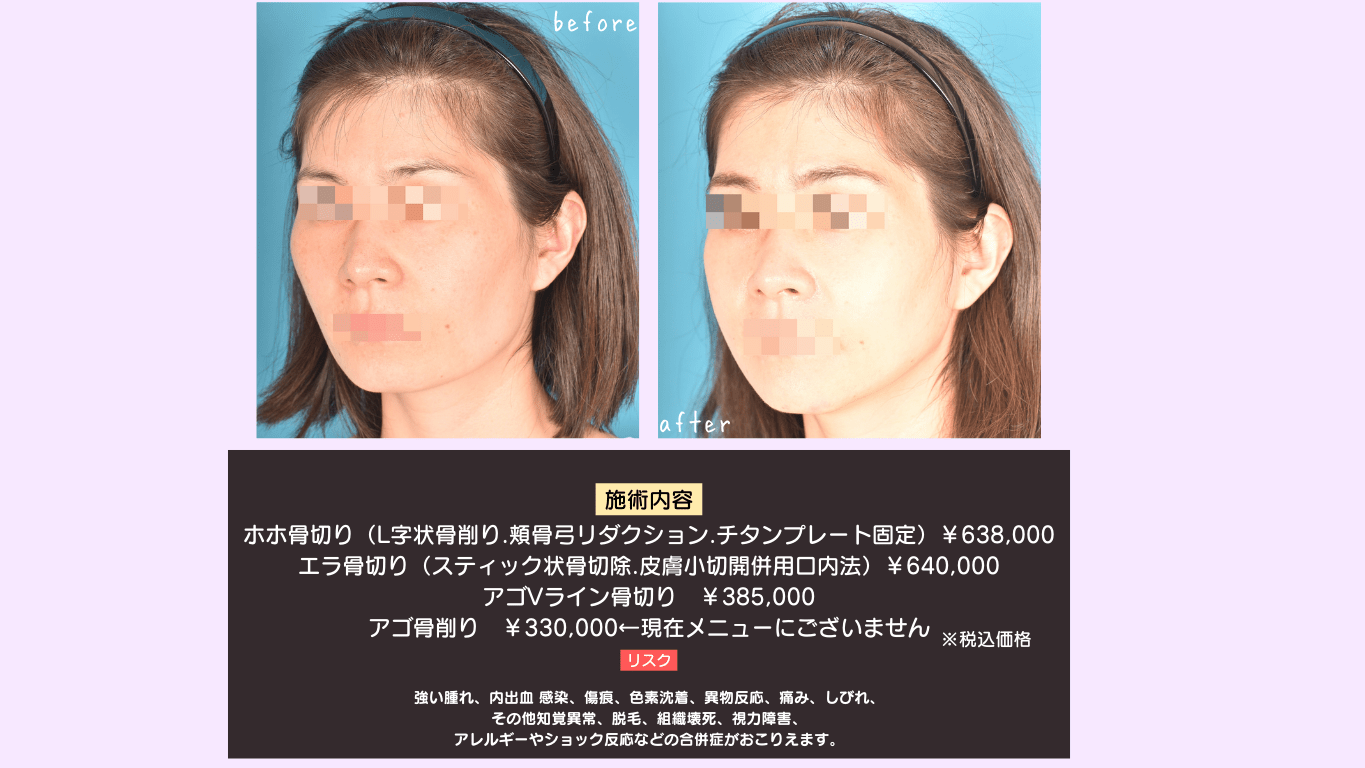 ホホ骨切り、顎骨切り、顎Vライン骨切り、エラ骨切り