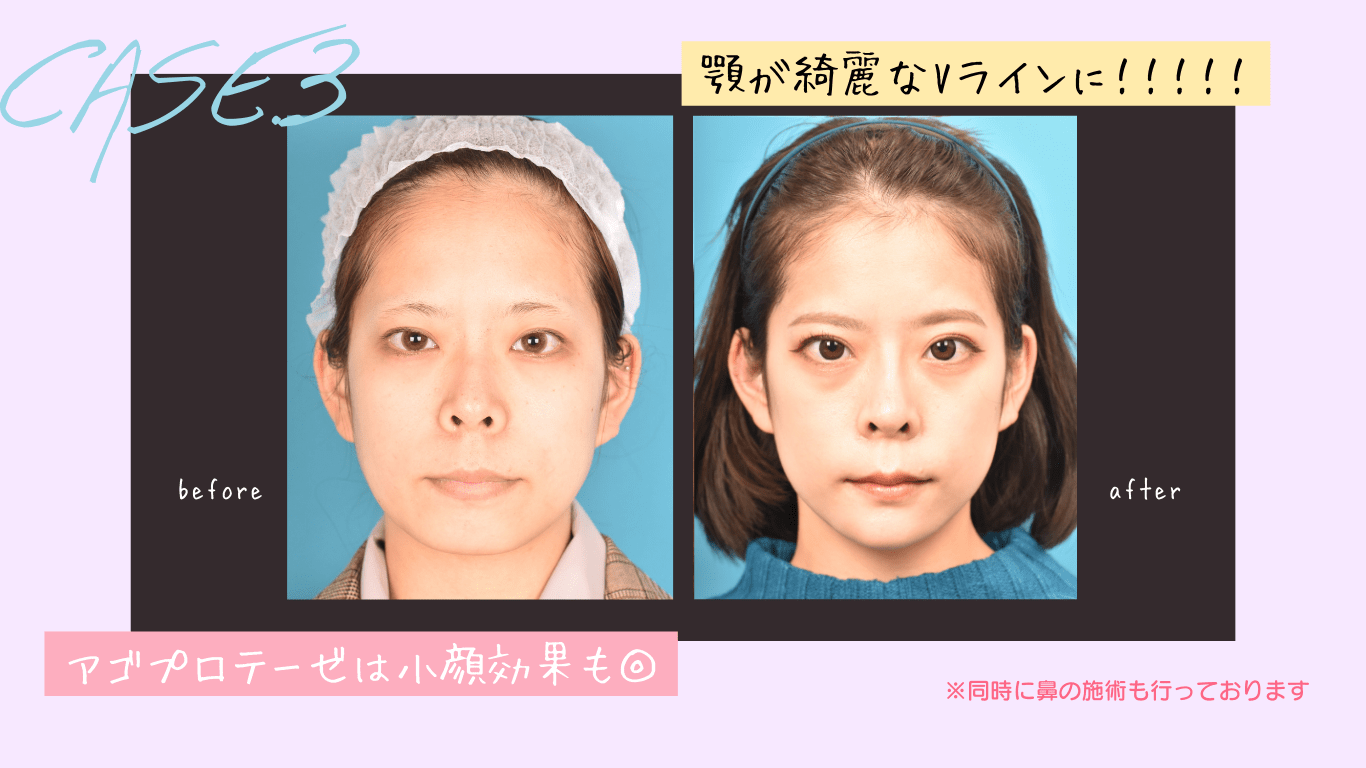 顎プロテーゼ