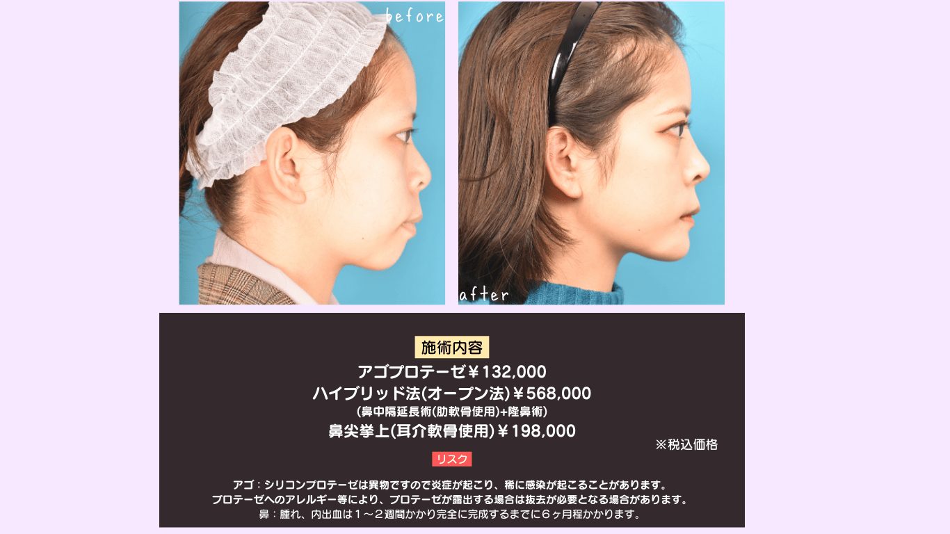 顎プロテーゼ