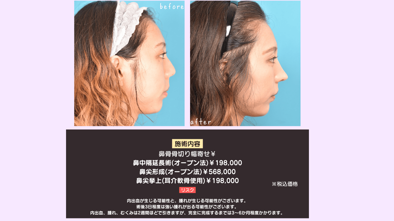 鼻骨骨切り幅寄せ