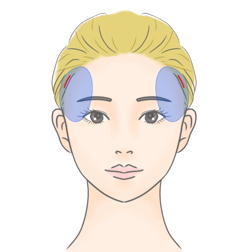 こめかみリフト