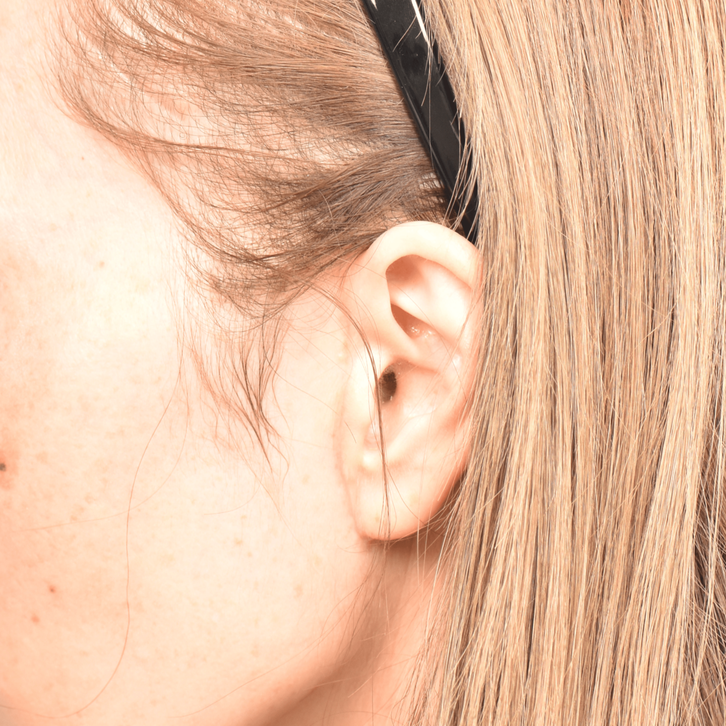 フェイスリフト傷跡3ヶ月後