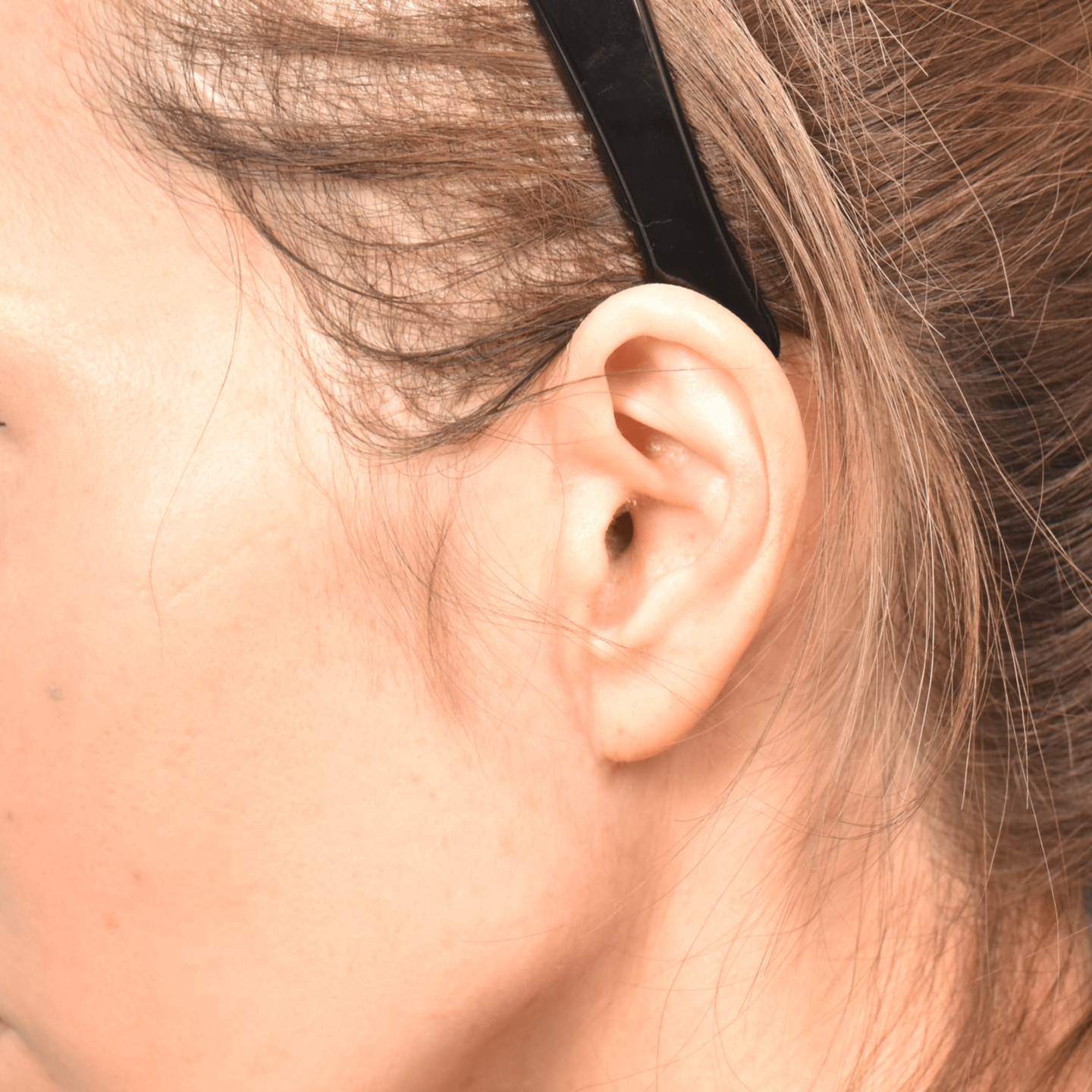 フェイスリフト傷跡6ヶ月